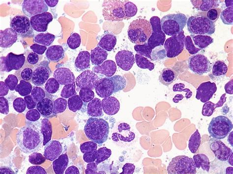 Fichero De Hematologia Macroglobulinemia De WaldenstrÖn