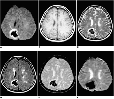A 49 Year Old Woman With Acute Intracerebral Hematoma Seen On Mr Images