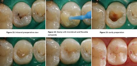 Figure 13 From Direct Posterior Composite Restorations Using Stamp
