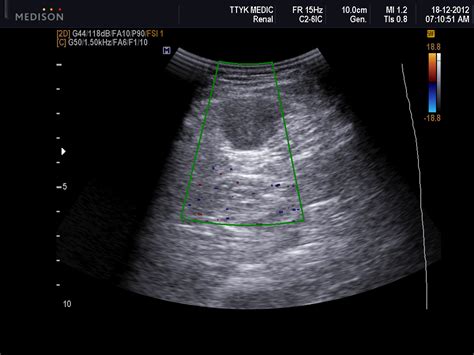Vietnamese Medic Ultrasound Case Intramuscular Mass Dr Phan