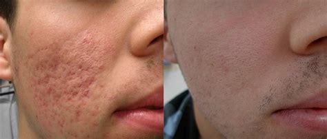 Radio Frequency Treatment For Acne Scars In Dubai Laser Skin Care