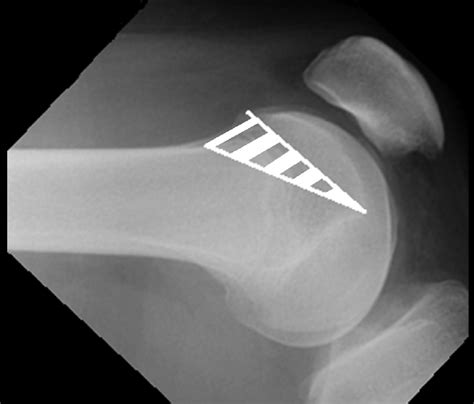 Preoperative Lateral Radiograph Showing Type Iii D Trochlear