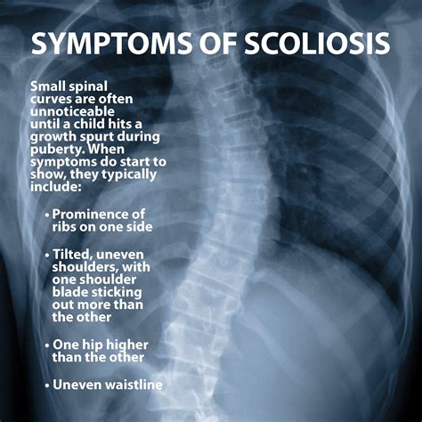 What Is A Scoliosis Scoliosis Causes Symptoms Spine Orthopedic The