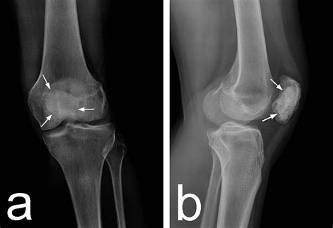 Cureus An Active Giant Cell Tumor Of The Patella A Case Report