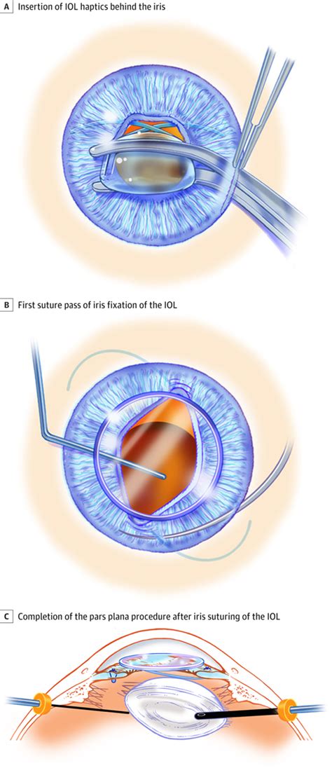 Iris Sutured Iol Placement With Crystalline Lens Extraction Allergy And Clinical Immunology