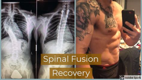 Spinal Fusion Surgery My Story Tips For A Full Recovery Youtube