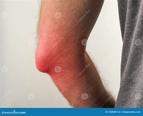 Man With Painful Elbow Or With Inflammation Stock Photo Image Of