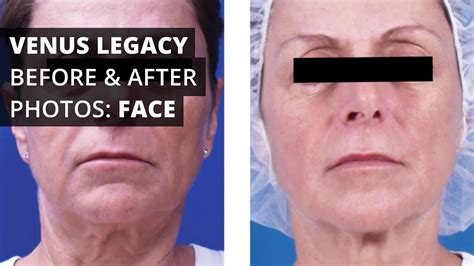 Venus Legacy™ Before And After Photos Face Youtube