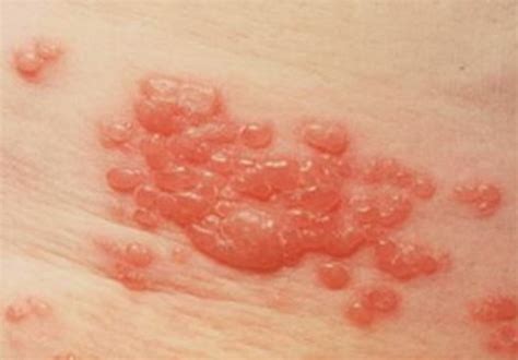 Itchy Skin Rash Pictures Causes Symptoms Treatment Hubpages