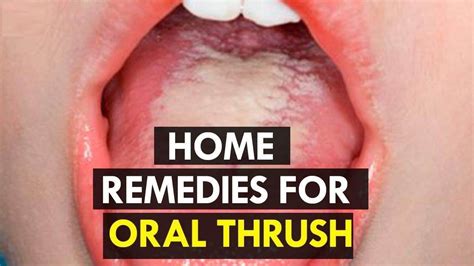 How To Treat Candida At Home 5 Home Remedies For Oral Thrush Youtube