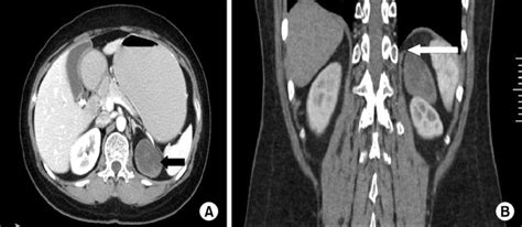 Abdominal Computed Tomography Scan A Axial Ct Finding There Was A