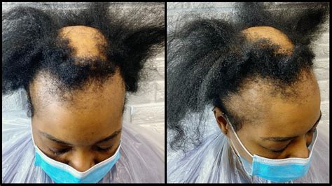 How To Cut Hair To Cover Bald Spot A Comprehensive Guide Senja Cosmetics