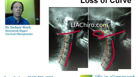 Reverse Neck Curve Auburn Hills Chiropractor Shows Cases Youtube
