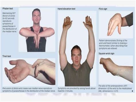 Nerve Compression Syndrome