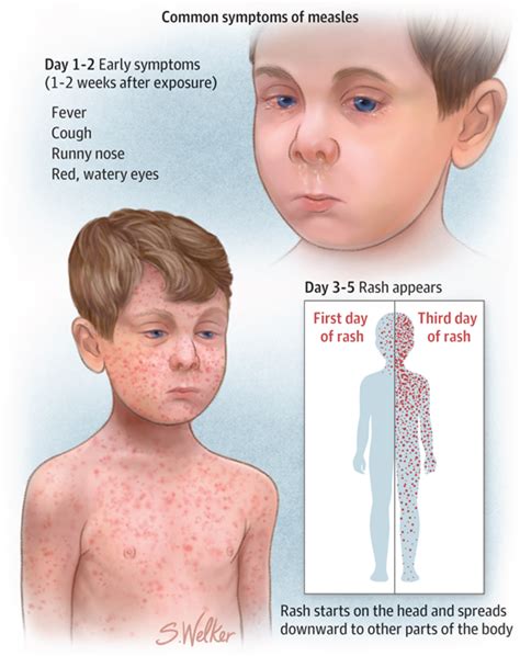 Recognizing Measles Infectious Diseases Jama The Jama Network