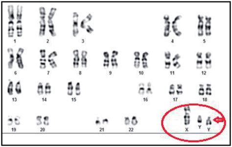 Karyotype Showing 47 Xyy Indicating Jacob Syndrome Or Xyy Syndrome