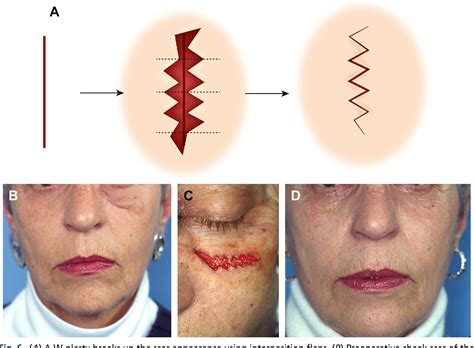 Figure 6 From Scar Revision And Recontouring Post Mohs Surgery