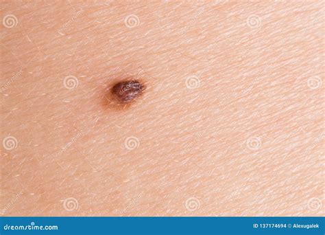 Large Mole On The Skin Close Up Stock Photo Image Of Patch Damaged