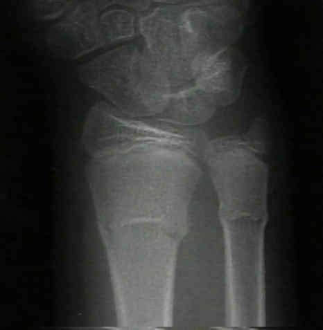 Fracture, torus. Causes, symptoms, treatment Fracture, torus