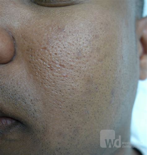Acd A Z Of Skin Acne Scars Acne Scarring