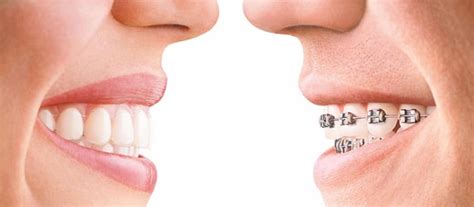 How To Know If You Need Braces Or Invisalign Everything You Need To Know About Invisalign Omar