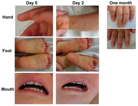 Ijms Free Full Text Enterovirus Associated Hand Foot And Mouth