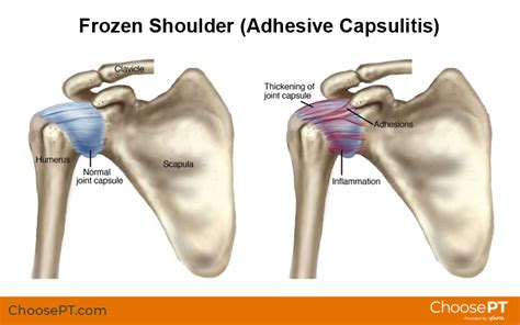 Guide Physical Therapy Guide To Frozen Shoulder Adhesive Capsulitis