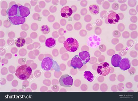 Mix Shape White Blood Cells Concept Funny Wbc Blood Smear Is Often