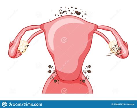 Causes Of Endometriosis Adenomyosis The Structure Of The Pelvic Organs With Endometriosis