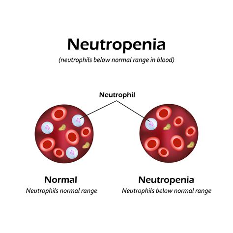 Neutropenia Causes Symptoms And Treatment Apollo Hospital Blog