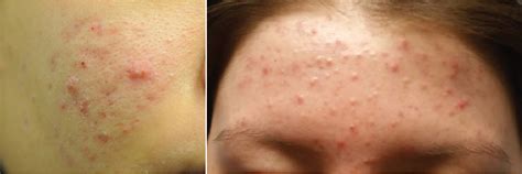 A Clinicians Guide To Treating Acne