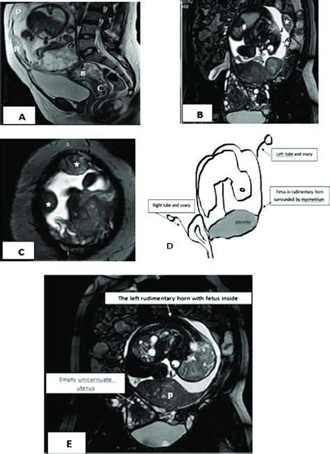 A E Unicornuate Uterus With Pregnancy In A Rudimentary Horn In Download Scientific Diagram