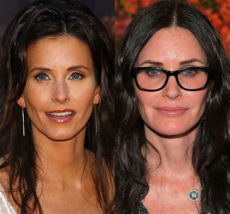Antes E Depois Veja A Transformação Das Famosas Que Usaram Botox