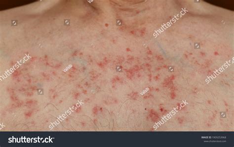 Rash Chest Stock Photos Images And Photography Shutterstock