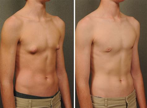 Male Breast Reduction For Gynecomastia Side Effects Of Testosterone