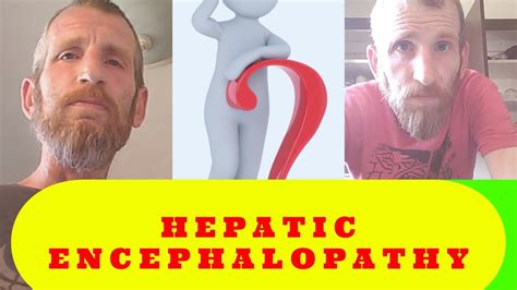 Hepatic encephalopathy is a syndrome and not a disease itself. Hepatic Encephalopathy Strikes Back - Liver Cirrhosis Vlog ...