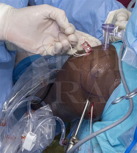 Arthroscopic Endobutton bone block stabilisation of shoulder with iliac