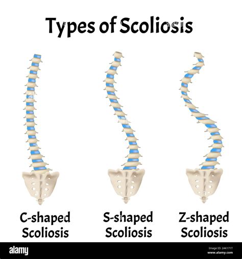 Scoliosis Curve Types