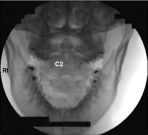 Figure 1 From Third Occipital Neurotomy For Suboccipital Neuralgic Pain