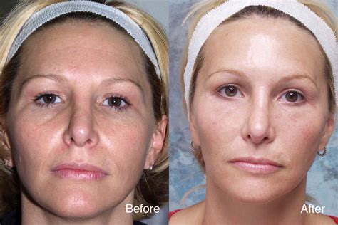 Midface Surgery Case Studies Beverly Hills Cheek Lift Cases Los Angeles