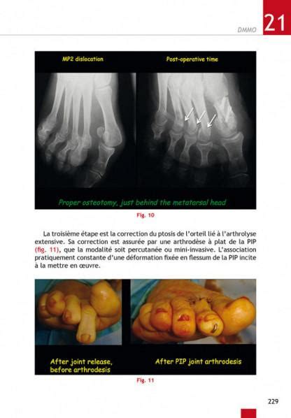 Chirurgie mini invasive et percutanée du pied ème édition Cazeau Sauramps Medical