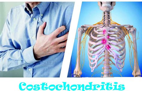 Costochondritis 1 Cawley Physical Therapy