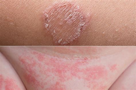 Skin Rash Causes Baby Skin Rash Allergy Fungal Treatment The Best Hot