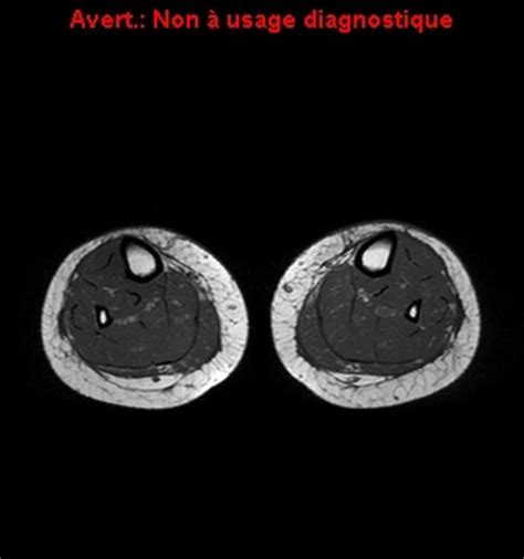Eosinophilic Fasciitis Radiology Case
