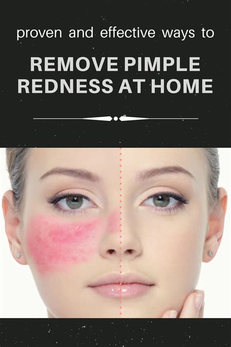 Home Remedies To Reduce Pimple Redness How To Remove Pimples Reduce