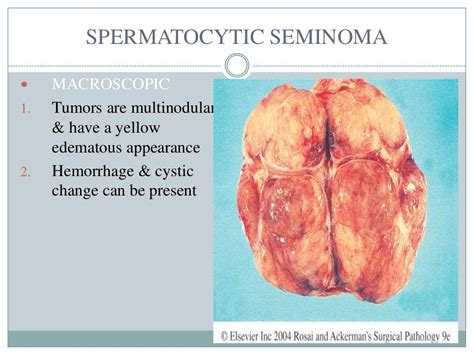 Testicular Tumors