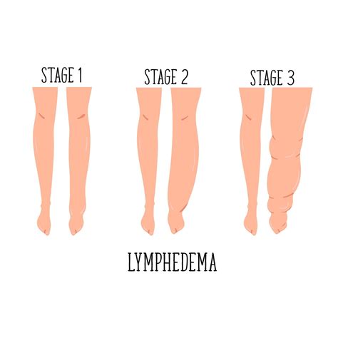 Lymphedema The Foundation To Advance Vascular Cures
