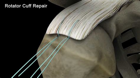 Slap Vs Rotator Cuff Repair Demo Video Youtube