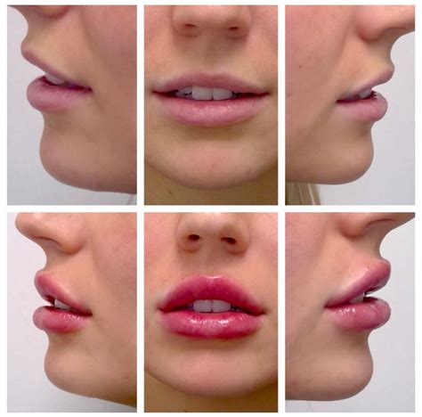 Lip Filler Kinds Permanent And Semipermanent Fillers While Tempting Are Not