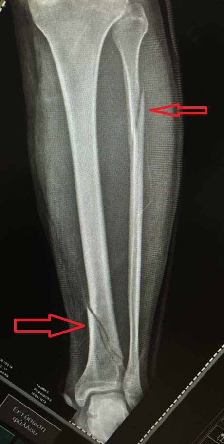 Tibial Fracture George D Goudelis Md Phd